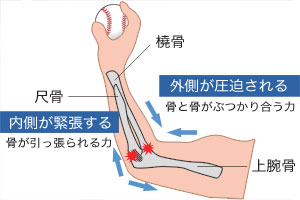 野球肘