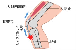 オスグッド病