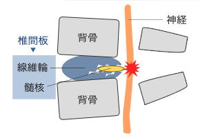 腰椎椎間板ヘルニア